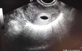 怀孕空囊还可以补救吗,空囊和胎停育哪个更好治愈？