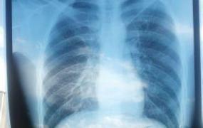 心影增大问题严重吗,双肺纹理增强是什么意思？